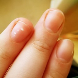 белые точки на ногтях рук