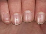 Белые точки на ногтях: о чем говорят эти знаки и что предпринять для их лечения?