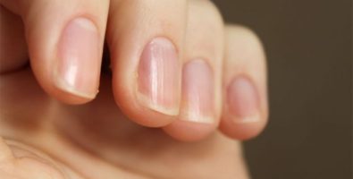 Причины появления ребристых ногтей на руках и как бороться с этой проблемой?