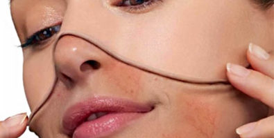 Обзор свойств кремов от купероза на лице