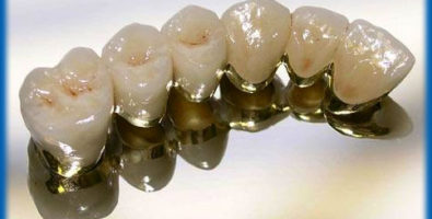 Уход за металлокерамическими зубами. Уход за зубами из металлокерамики