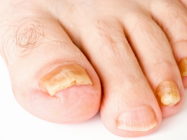 Утолщение ногтей на ногах – ваш организм в опасности!