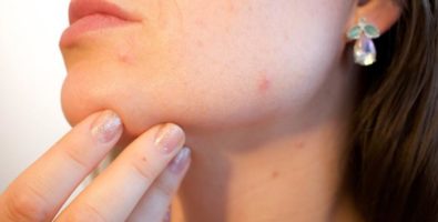 Гнойные прыщи на лице – причины появления и способы лечения, рекомендации по профилактике